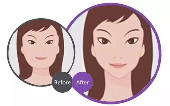 隆下巴后 意想不到的变化