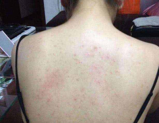 秋季晚上洗澡时, 在身上搓1种东西, 7天痘痘全无, 还你光滑后背