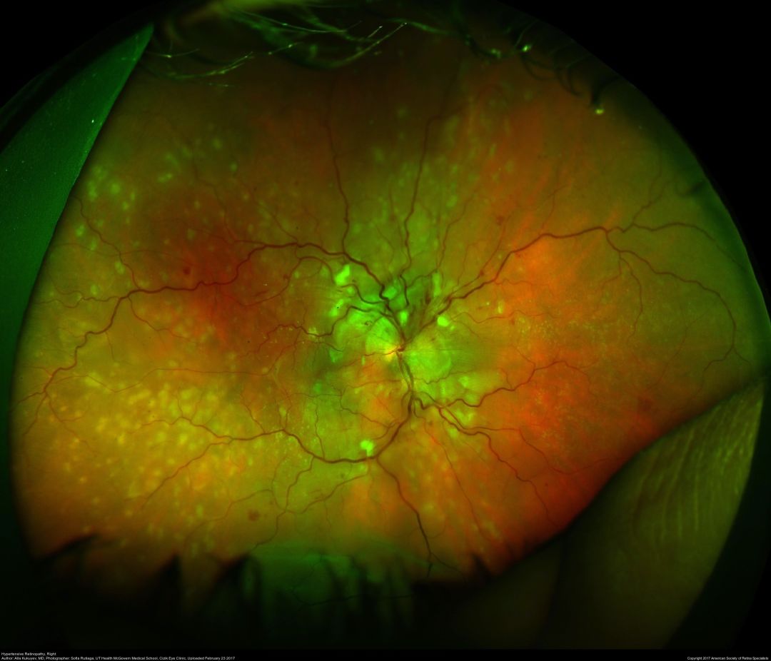 视网膜血管性疾病——4、家族性渗出性玻璃体视网膜病变 - 知乎