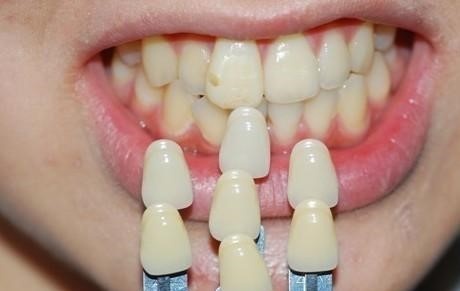 根管治疗的价格包括牙冠吗?