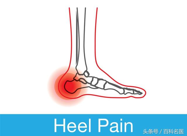 一走路就脚后跟疼,多半是这3种“病”!