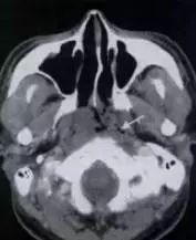 几个NK\/T细胞淋巴瘤的典型病例