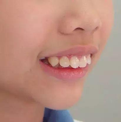 有一些牙颌畸形需要早期进行治疗(3-5岁),如地包天,咬唇,吮指等不良