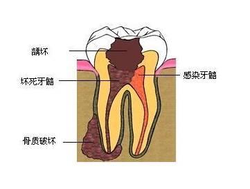 治愈牙周炎预计花费要多少?