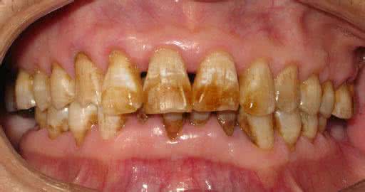 牙齿为什么会暗沉变黑变黄?