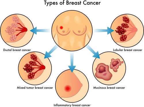 关于乳腺癌的报销政策 乳腺癌农村医保报销比