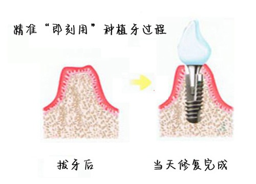 在武汉种植牙能不能一天就能种植好的？原来是可以的！(图1)