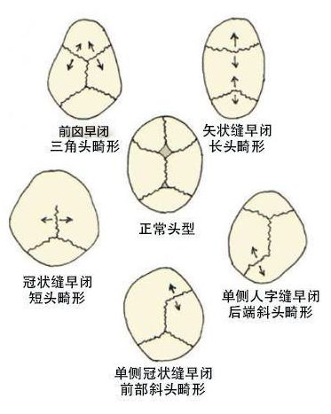 正文 每块颅骨片之间都会有缝隙,且尚未完全融合,其中囟门(前囟,后