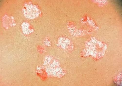 正文 癣病是由于浅表部真菌感染引起的皮肤病,致病真菌有红色毛癣菌