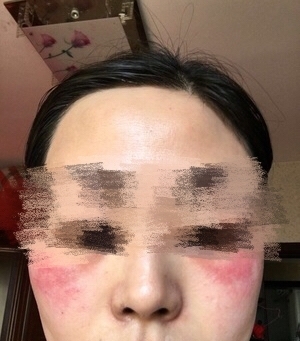 女子购买微商护肤品导致面部过敏,后查为假冒产品