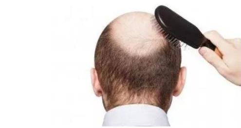 很多人都有脱发的烦恼,想要恢复浓密的头发,发友们可以选择毛发移植