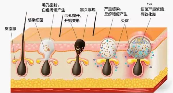 黑头瞬间被吸走80%!皮肤滑嫩0毛孔，素颜也像化了妆!