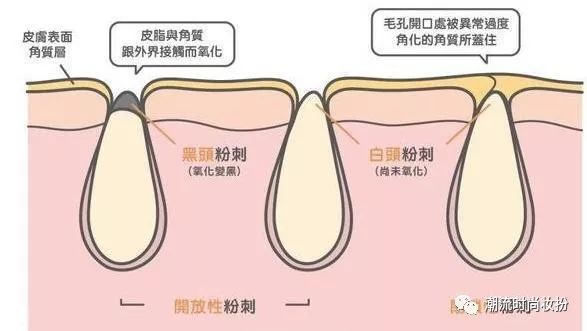 闭合粉刺不要怕，教你轻松解决