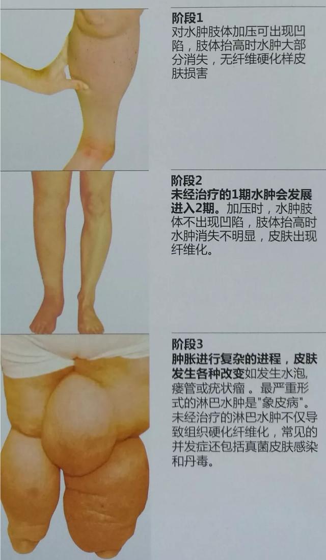 女子13年前做过乳腺癌手术,现手臂"水肿"衣服穿不下?怎么回事