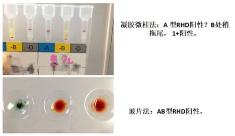 检验临床面对面玻片法ab型凝胶微柱卡a型怎么解