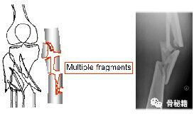 (粉碎性)骨折骨折 缩短成角旋转 该片的正确描述:1左股骨的短斜型骨折