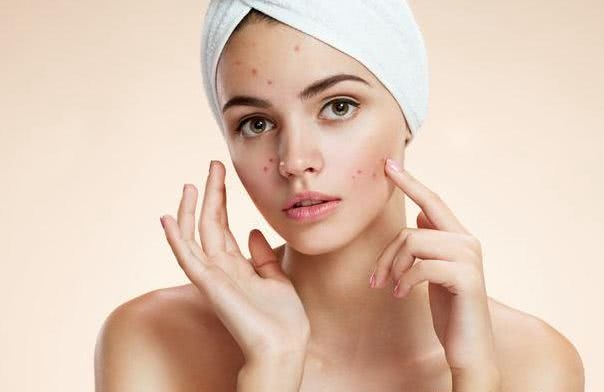 脸上各个部位长痘，原因各不相同，叶子老师教你针对性祛痘