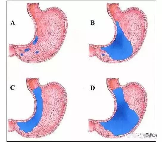 胃腺体萎缩、肠化、异型增生并没你想象的那么可怕!