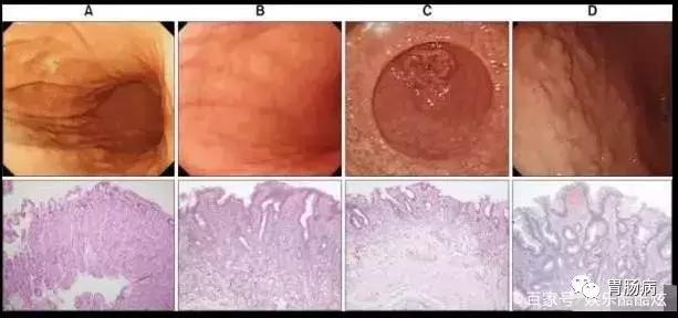 胃腺体萎缩、肠化、异型增生并没你想象的那么可怕!