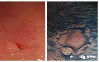 胃腺体萎缩、肠化、异型增生并没你想象的那么可怕!