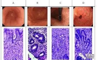 胃腺体萎缩、肠化、异型增生并没你想象的那么可怕!
