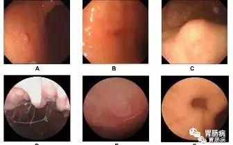 胃腺体萎缩、肠化、异型增生并没你想象的那么可怕!