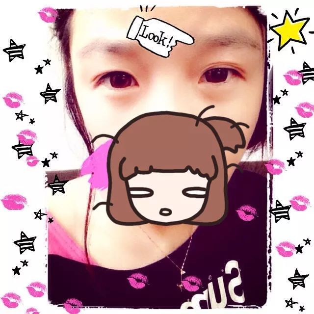 lxl和fbb相约去开的双眼皮,居然是同做项目的周