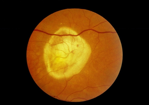 高度近视眼:常见的眼底病变的3种类型