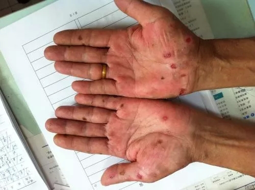 如何区别手部湿疹和手癣?(临沂中科皮肤病