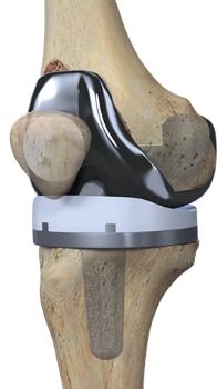 图解人工全膝关节置换术