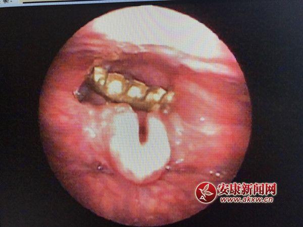 喉咙卡东西图片图片