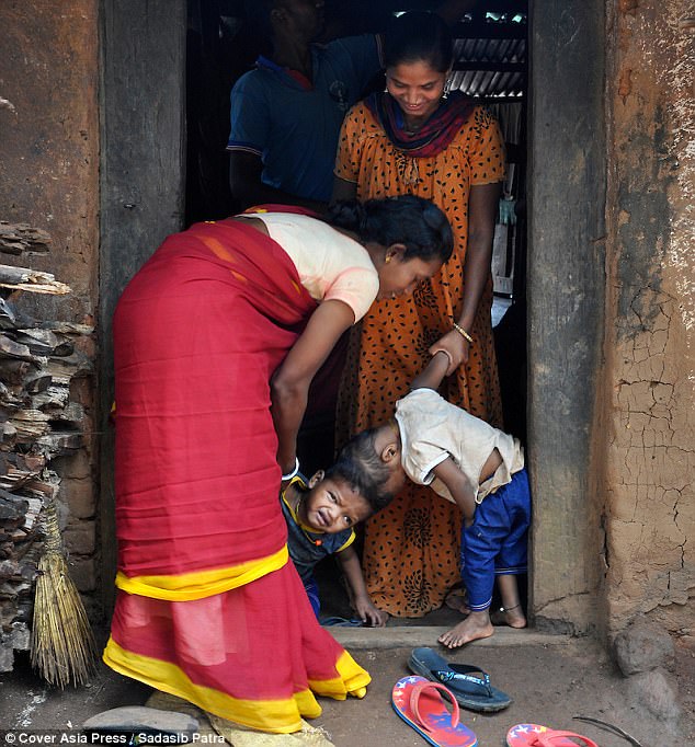 印度头部连体双胞胎分离手术成功 历经11小时