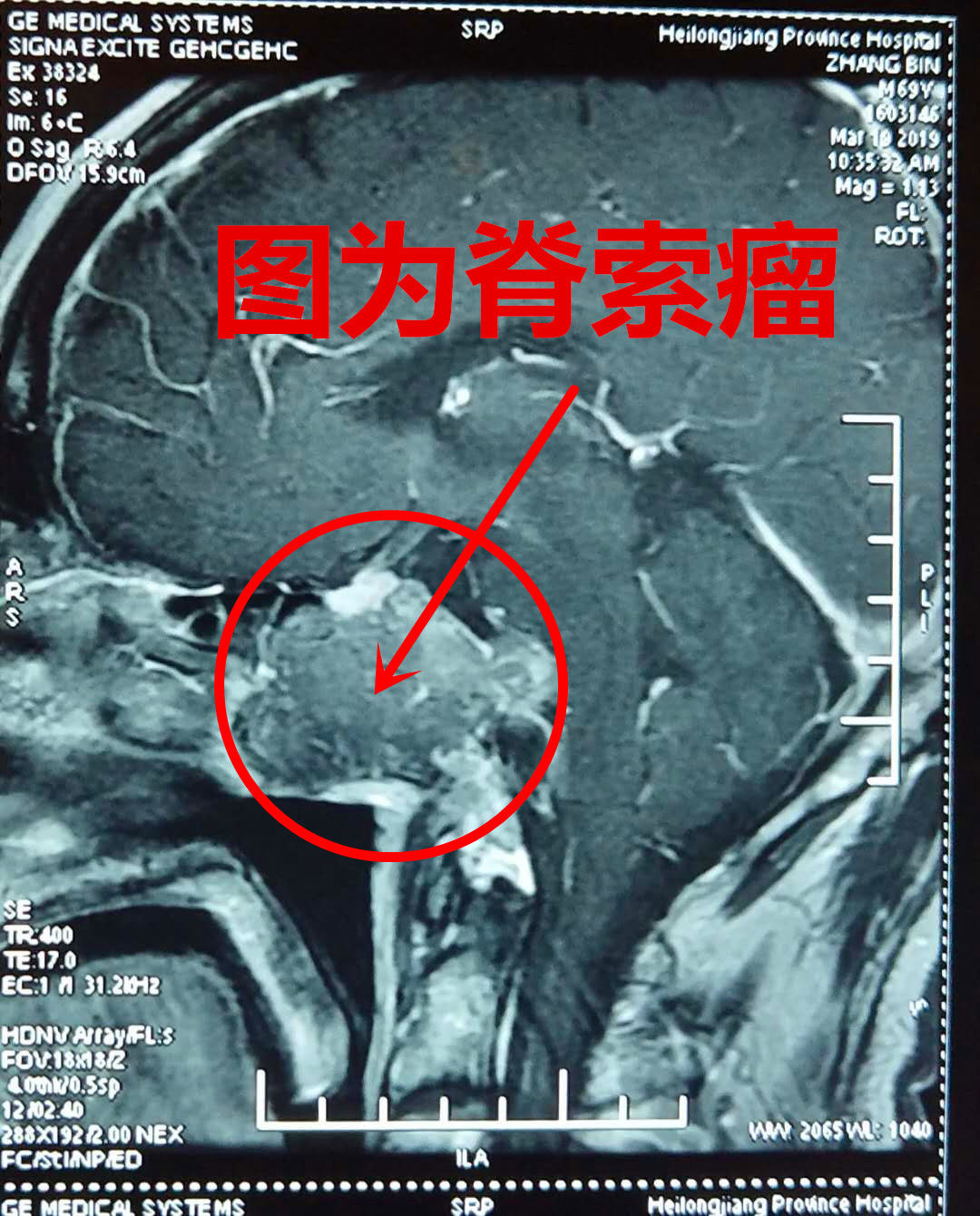 黑龙江省医院神经内镜下成功完成脊索瘤切除术