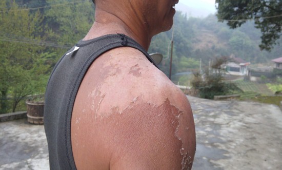 王新法被晒伤,磨破的皮肤对于薛家村村民来说,王新法为村里做的每一件