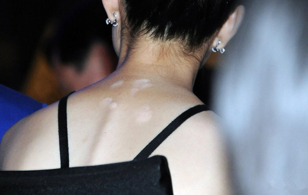 倪妮美背出现大片粉底 疑遮盖斑痕所留,网友:涂均匀一点吧