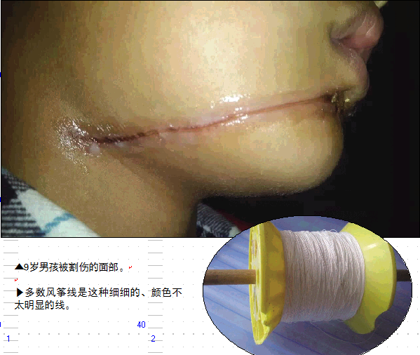 男孩脸上的伤疤触目惊心