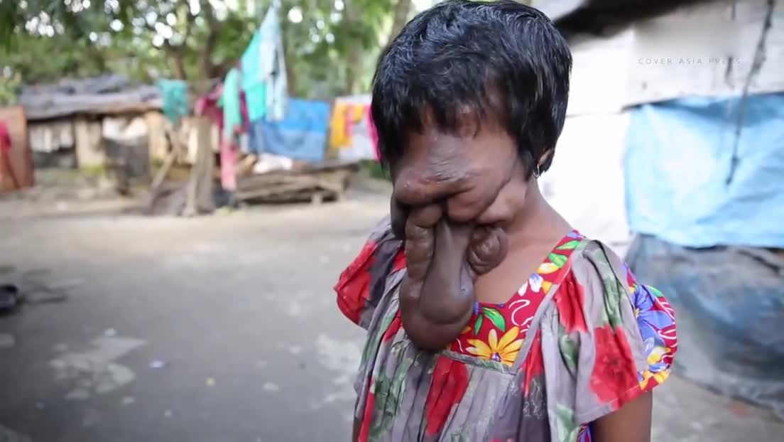 印度花季少女得怪病 巨瘤遮住整张脸