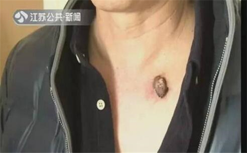 一颗痣三年后变癌 哪种黑痣易癌变