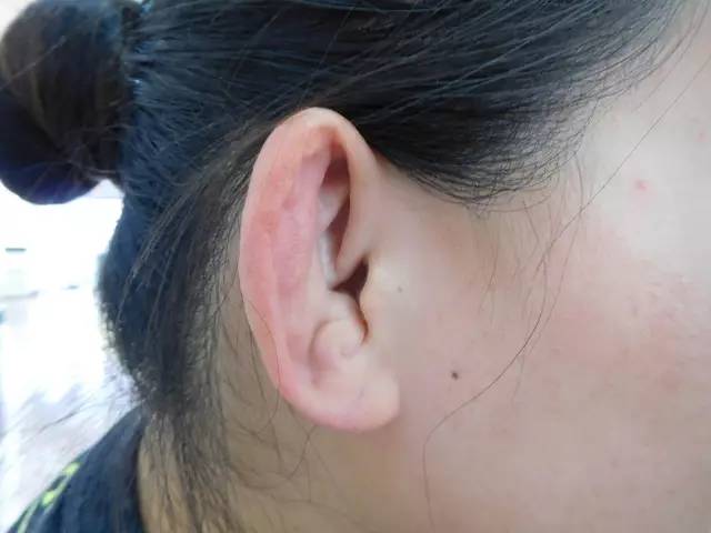 学校的女子摔跤队教练 摔跤运动员特有的"饺子耳"是什么导致的原因?