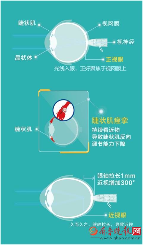 目前市場上許多宣稱能防治近視眼的產品和措施都是針對讓睫狀肌放鬆而