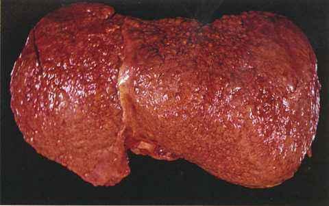 三大信号警示可能你的肝出现肝硬化了肝脏排毒法让你的肝不再硬