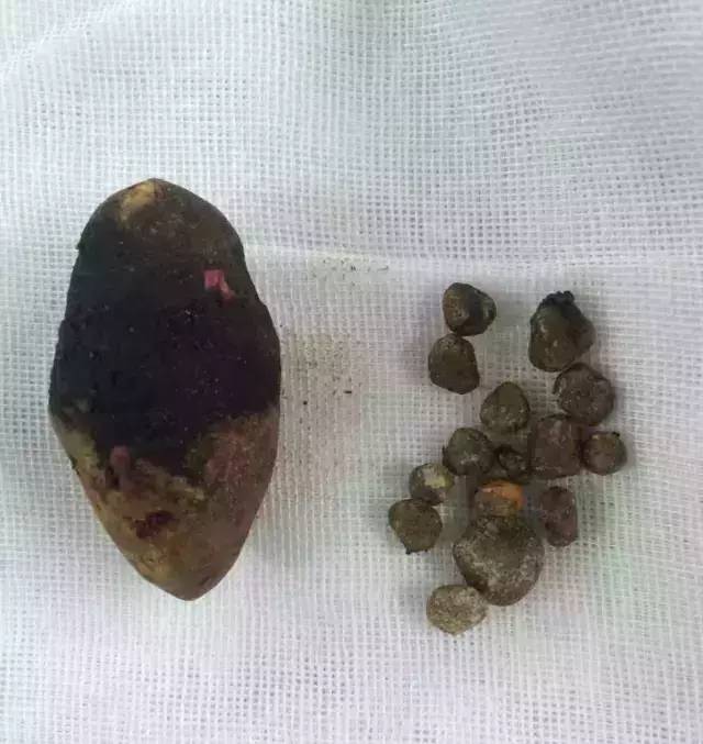 胆色素结石:这也是我国常见的一种胆结石类型,由胆色素,少量钙盐和