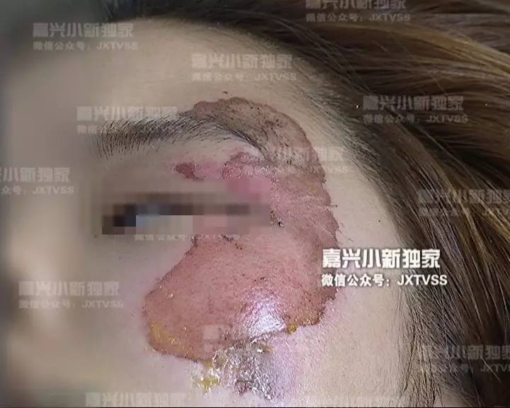 18歲女孩車禍倒地沒想到又被燙傷大腿和臉都傷得不像樣了