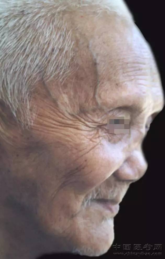密集恐惧症及非医护人员慎点!史上最全的皮肤病图谱来了(修订版)!_凤