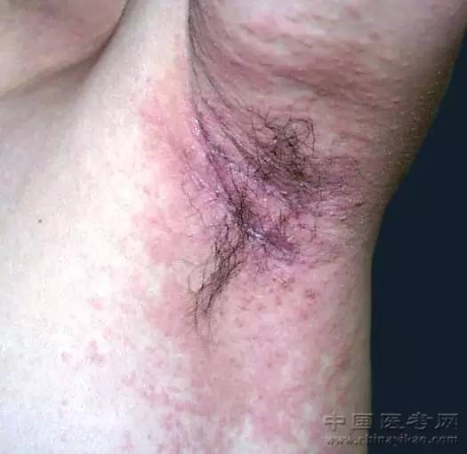 史上最全的皮肤病图谱来了(修订版)!