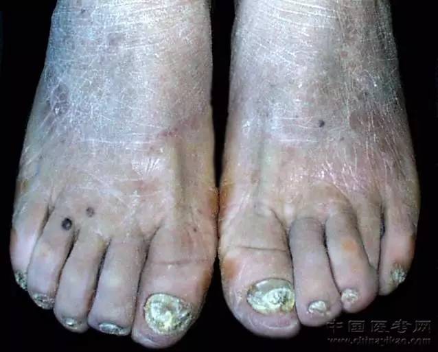 密集恐惧症及非医护人员慎点!史上最全的皮肤病图谱来了(修订版)!