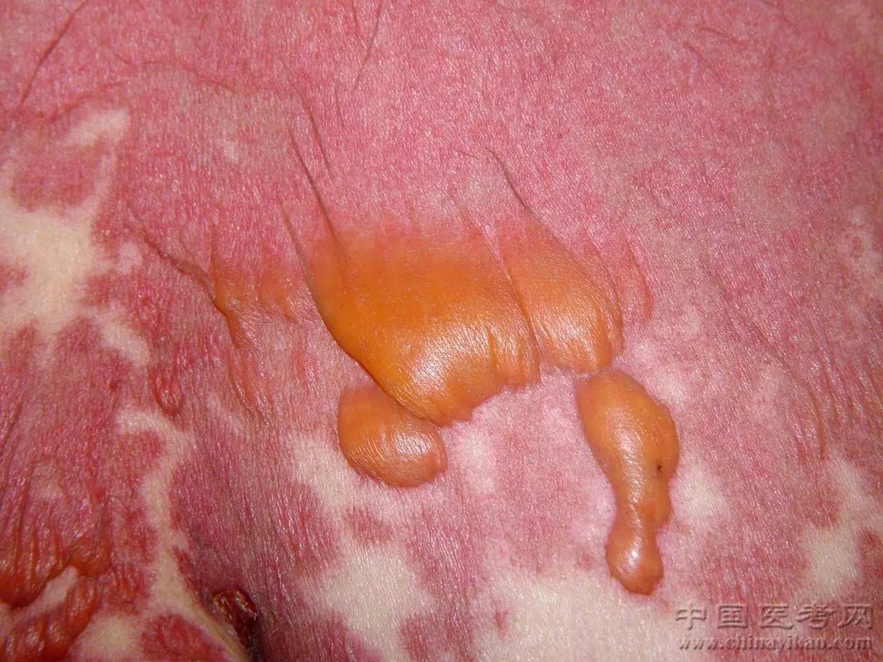 密集恐惧症及非医护人员慎点!史上最全的皮肤病图谱来了(修订版)!