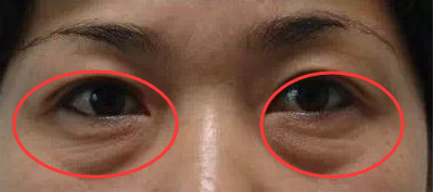 脸部眼袋加重每天敷点它早晚各一次轻松去除眼袋黑眼圈