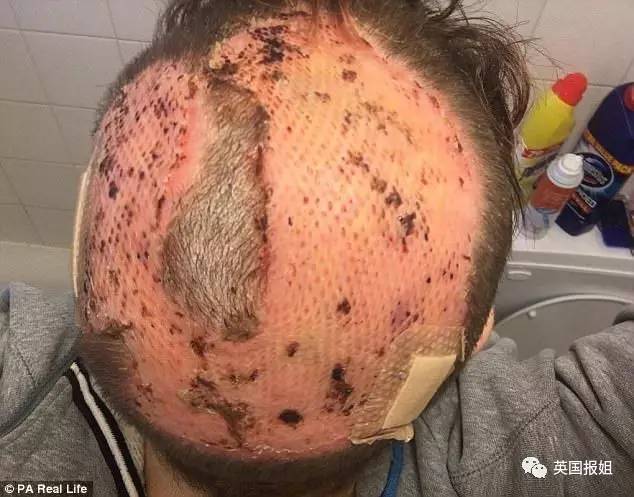 英国女子为省钱自己染发严重灼伤头皮,3个星期内接受了6次手术!