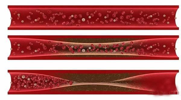 血管被斑块堵了70%,1剂古方,30天扫除多年血管垃圾